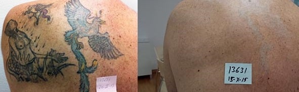 Eliminación de tatuajes con el Láser Q-Switched: ¡Mirad los resultados!