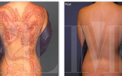 Tratamientos más eficaces para eliminar tatuajes