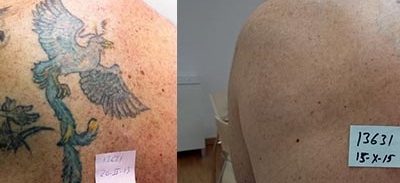 Eliminación de tatuajes con el Láser Q-Switched: ¡Mirad los resultados!